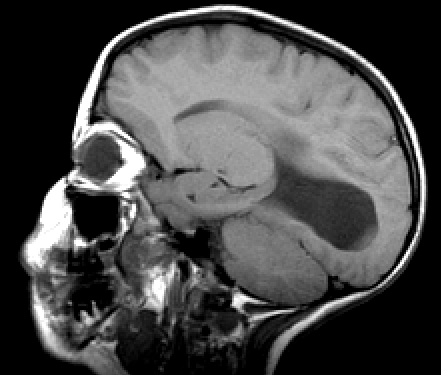 Corpus callosum avvik Mattson et al.