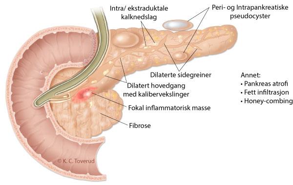 Transabdominal ultrasound of the ancreas: Basic