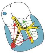 Grenblokk gir brede QRS v1 v6