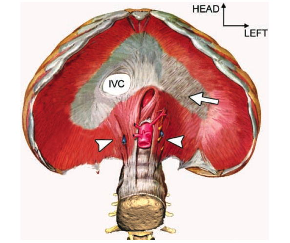 Fig 1: Normal diafragmaanatomi. Hullet til vena cava inferior merket IVC, Pilen viser sentralsenen, Pilhoder peker på crurae sin. og dext.