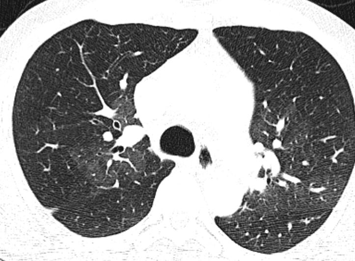 CT fra henvisende sykehus CT angiografi viser dilaterte sentrale lungearterier, stenotiske