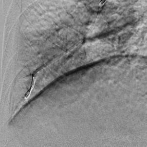 PTA (= Percutan transluminal angioplastikk) utført mot et stort antall lungearteriegrener på segment og subsegmentnivå i