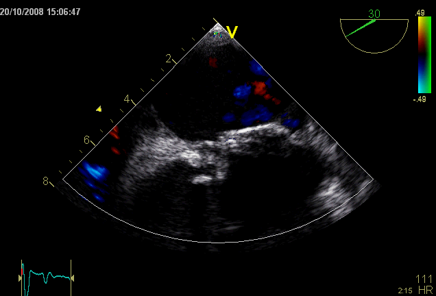 MVR bioprotese, endokarditt, TEE Ventilløsning