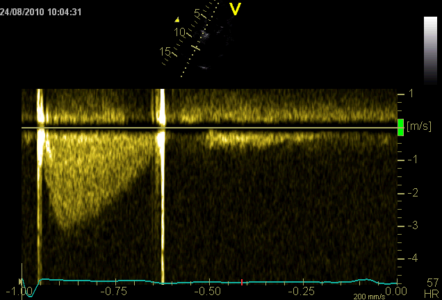 Eval. AVR: EkkoDoppler Maksimal blodstrømshast, Vmax < 3.