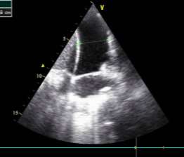 Pleura sensitiv for sviktforverring Sviktforverring 77%