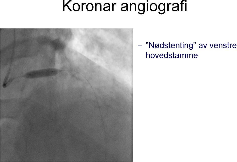 Nødstenting