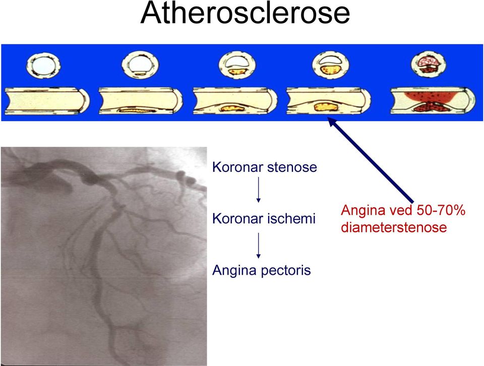 Angina ved 50-70%