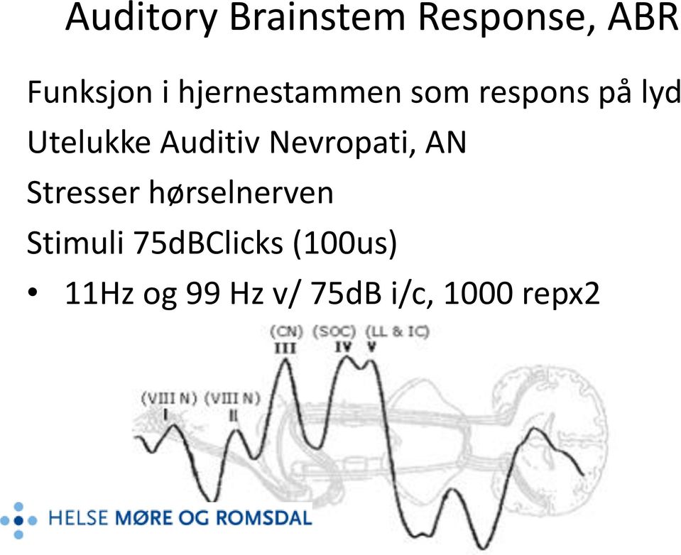 Auditiv Nevropati, AN Stresser hørselnerven