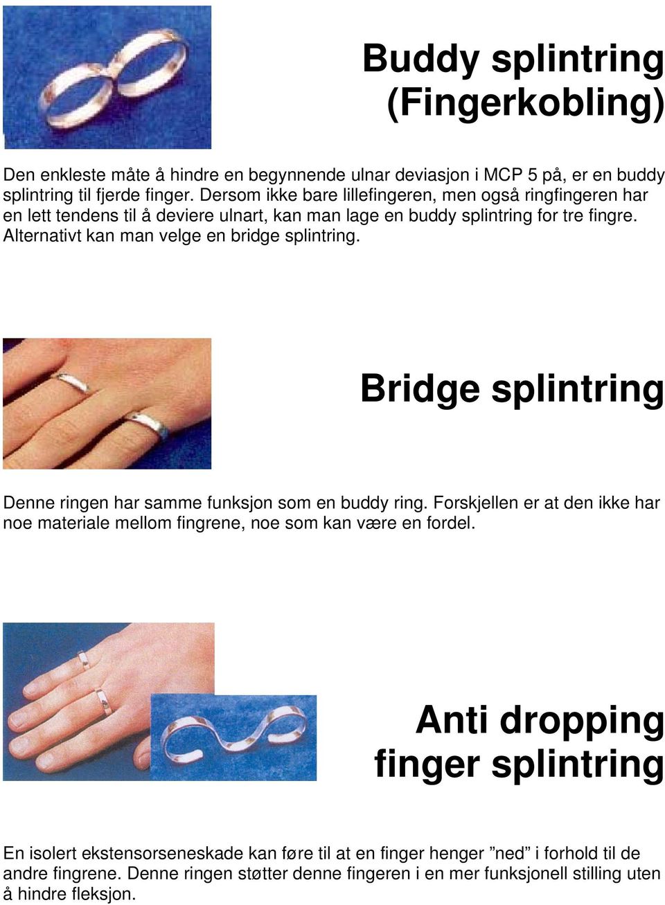 Alternativt kan man velge en bridge splintring. Bridge splintring Denne ringen har samme funksjon som en buddy ring.