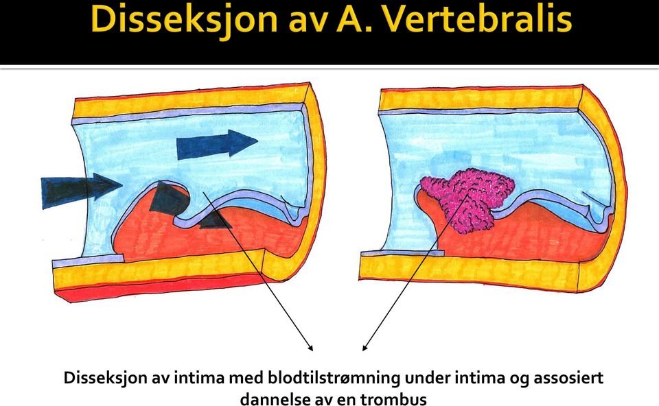 under intima og