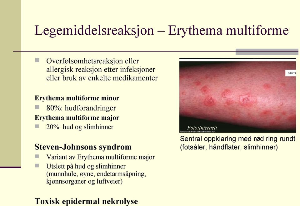 Steven-Johnsons syndrom Variant av Erythema multiforme major Utslett på hud og slimhinner (munnhule, øyne, endetarmsåpning,
