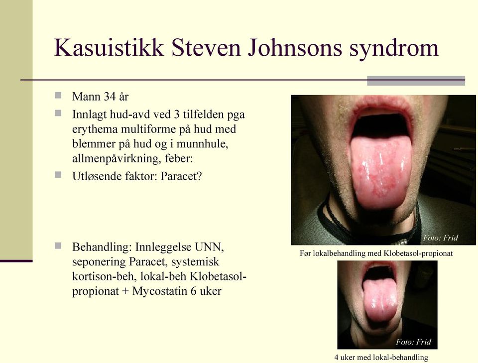 Behandling: Innleggelse UNN, seponering Paracet, systemisk kortison-beh, lokal-beh Klobetasolpropionat +