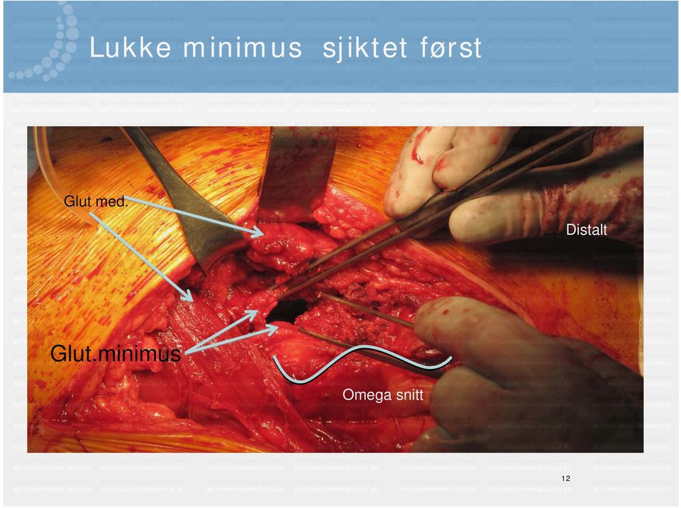 med. Distalt Glut.