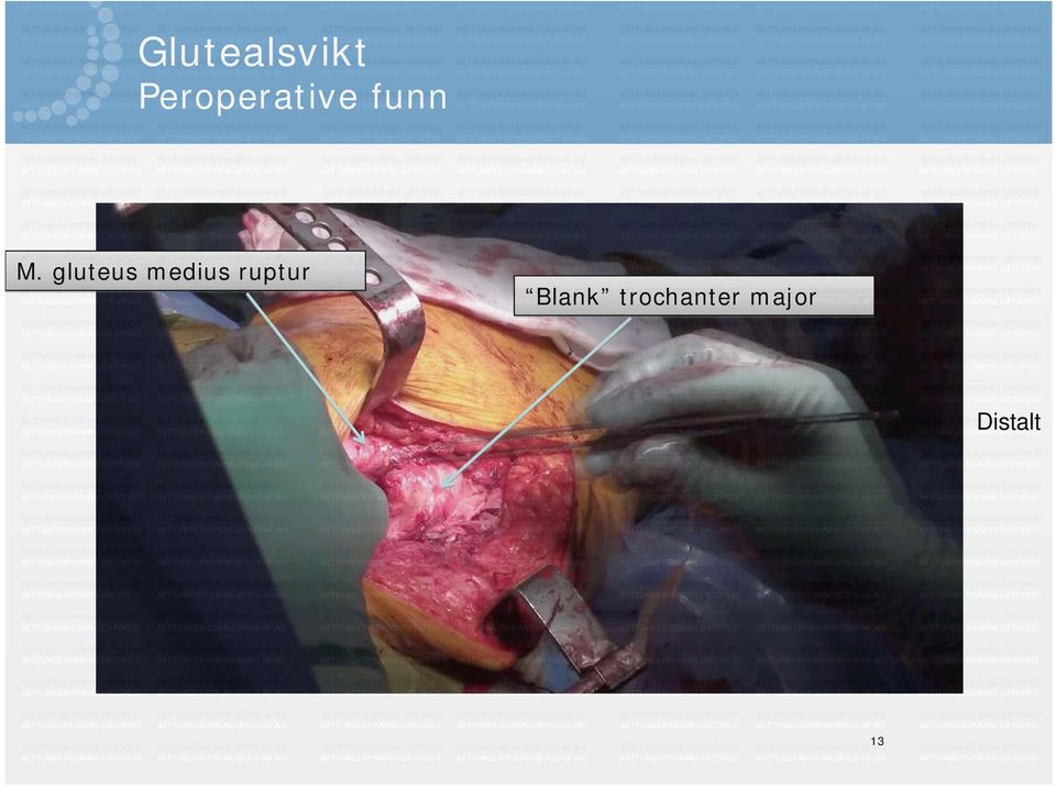 gluteus medius ruptur