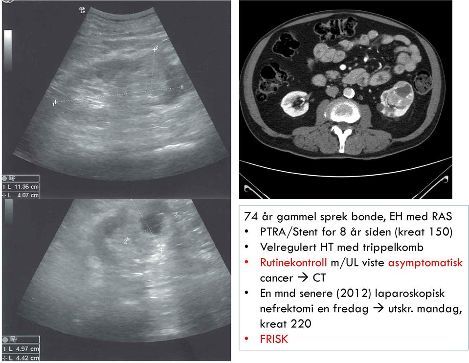 Rutinekontroll m/ul viste asymptomatisk cancer CT En mnd