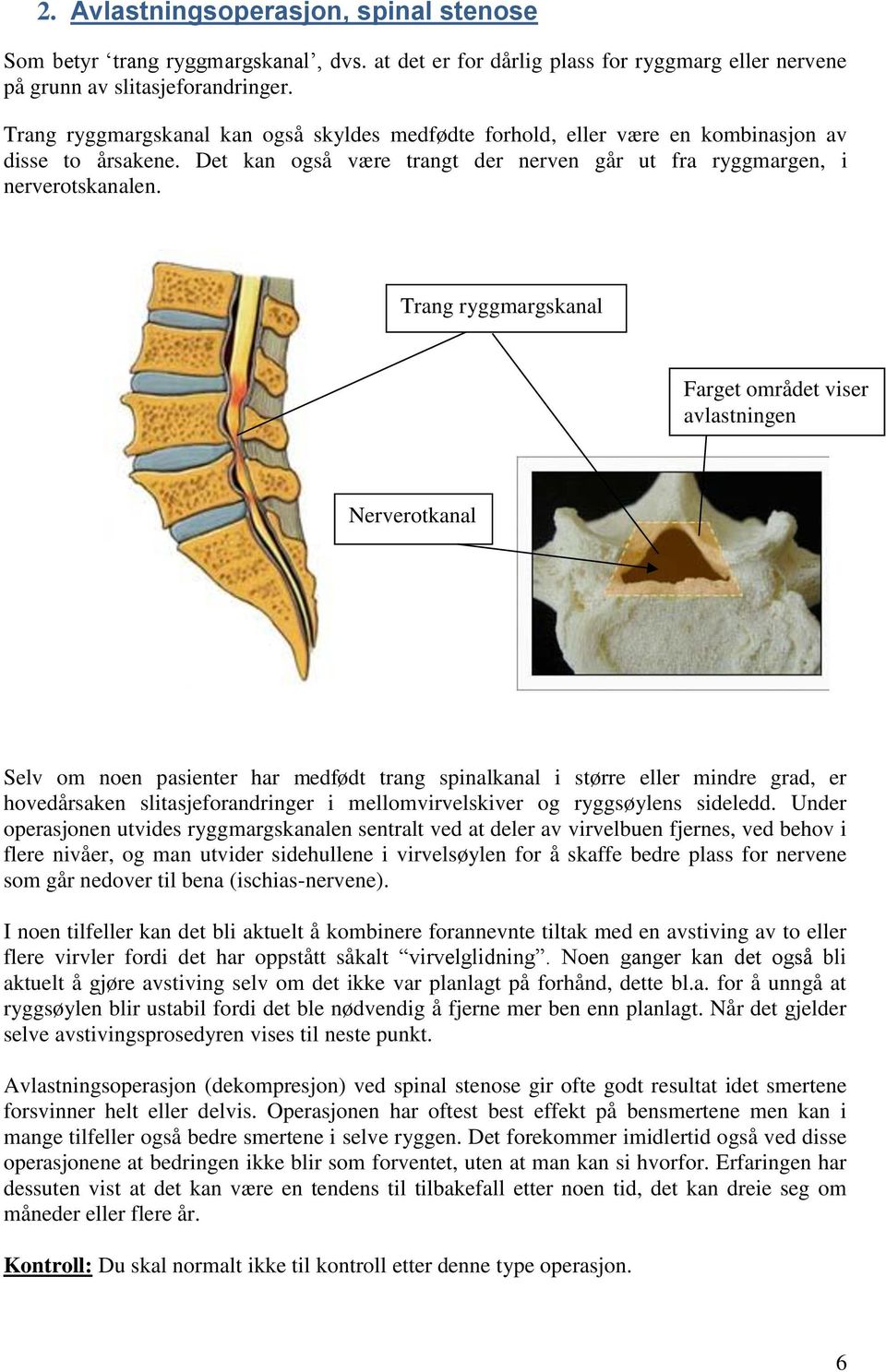 Trang ryggmargskanal Farget området viser avlastningen Nerverotkanal Selv om noen pasienter har medfødt trang spinalkanal i større eller mindre grad, er hovedårsaken slitasjeforandringer i
