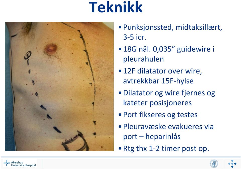 15F-hylse Dilatator og wire fjernes og kateter posisjoneres Port