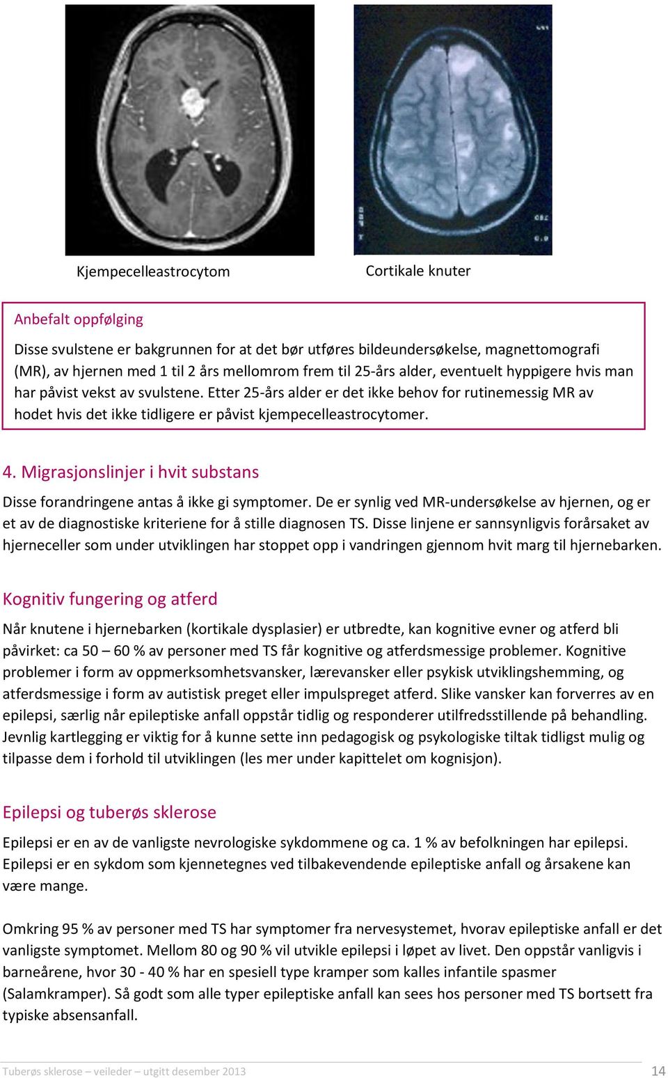 4. Migrasjonslinjer i hvit substans Disse forandringene antas å ikke gi symptomer. De er synlig ved MR-undersøkelse av hjernen, og er et av de diagnostiske kriteriene for å stille diagnosen TS.