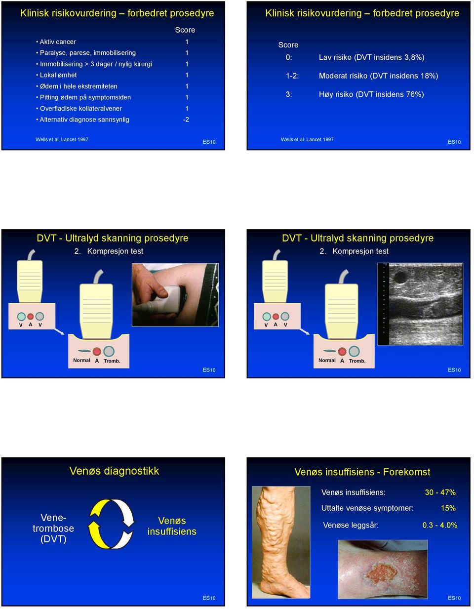 insidens 18%) 3: Høy risiko (DVT insidens 76%) Wells et al. Lancet 1997 Wells et al. Lancet 1997 DVT - Ultralyd skanning prosedyre 2. Kompresjon test DVT - Ultralyd skanning prosedyre 2.