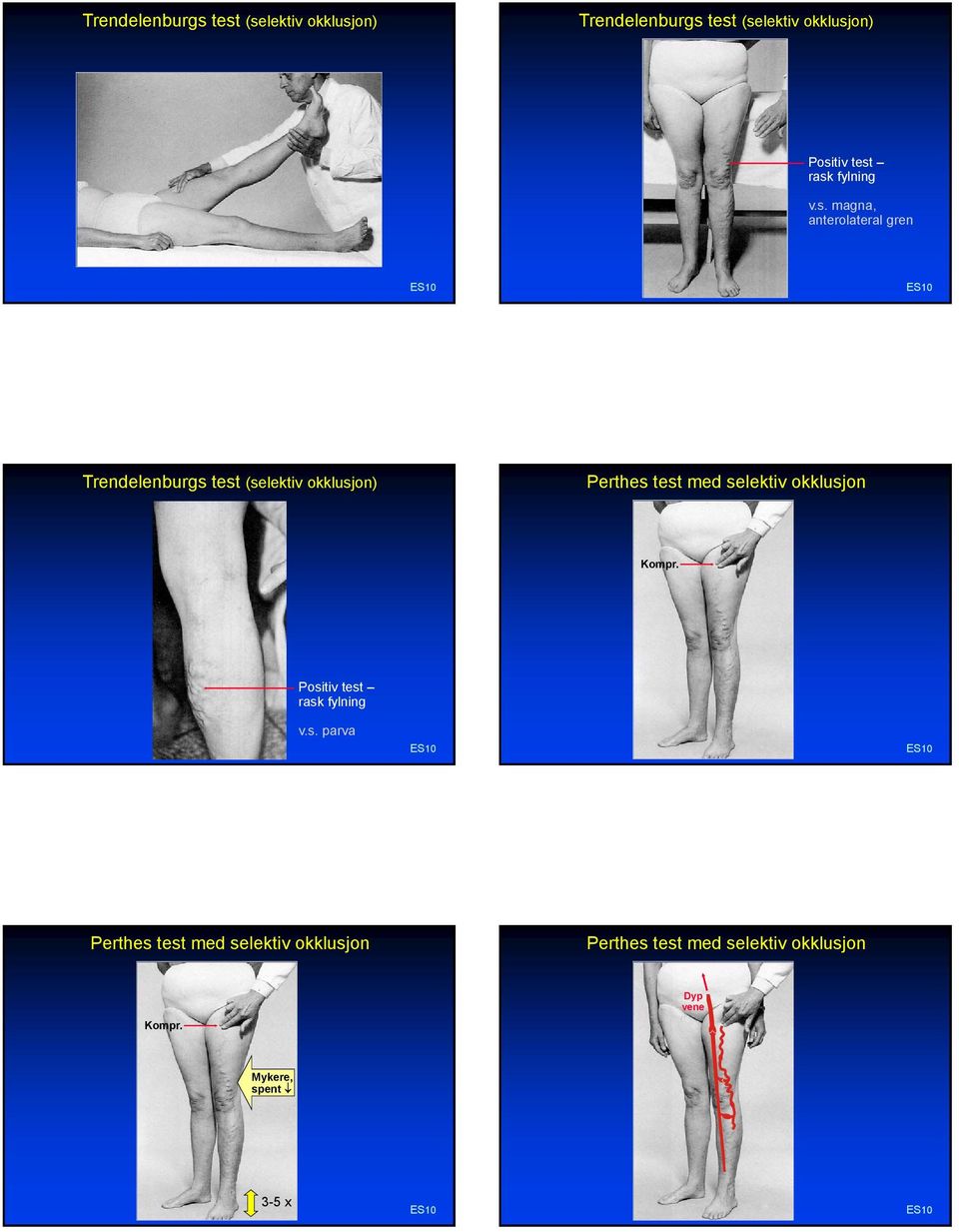 magna, anterolateral gren Trendelenburgs test (selektiv okklusjon) Perthes test med selektiv