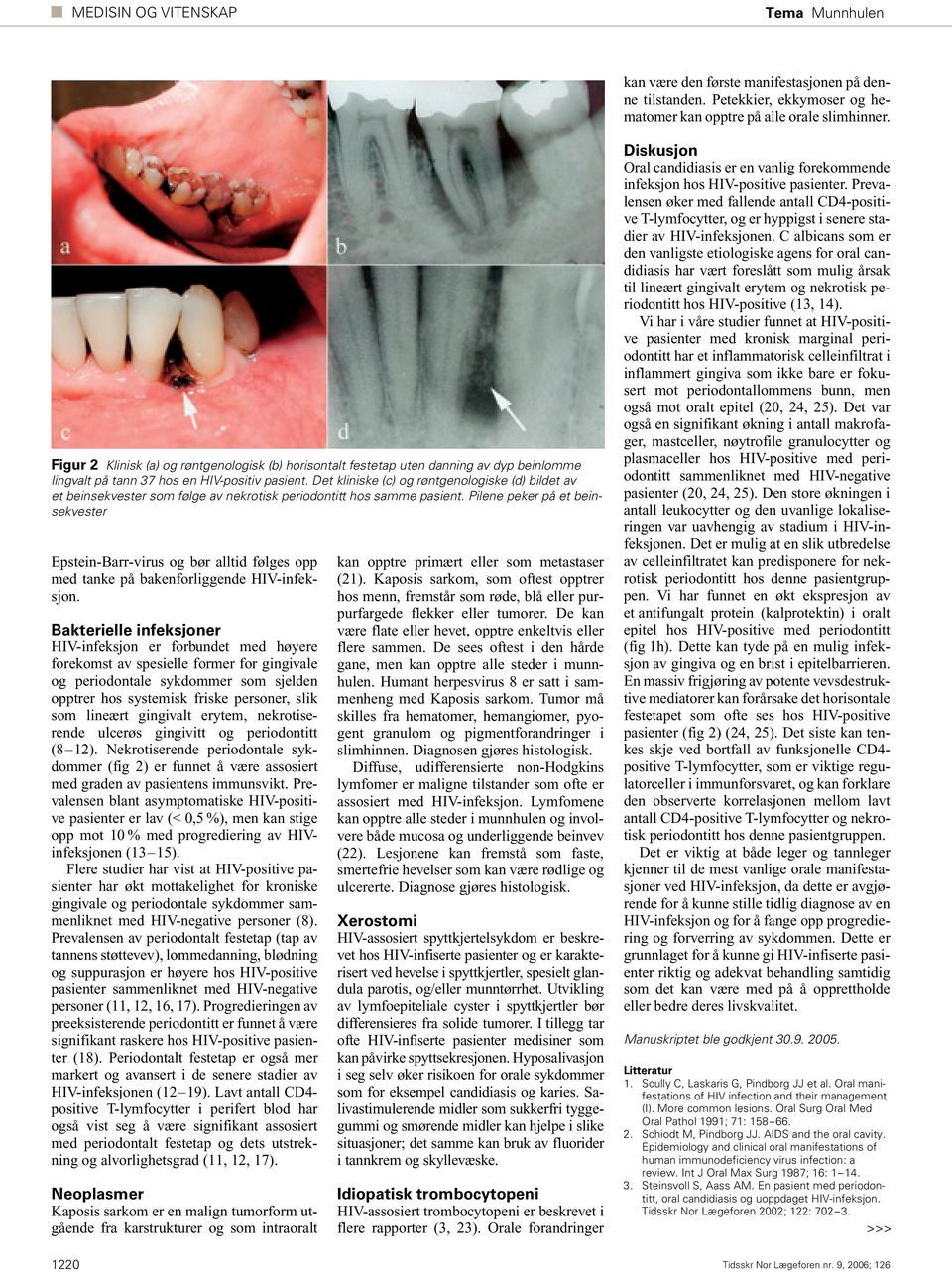 Det kliniske (c) og røntgenologiske (d) bildet av et beinsekvester som følge av nekrotisk periodontitt hos samme pasient.