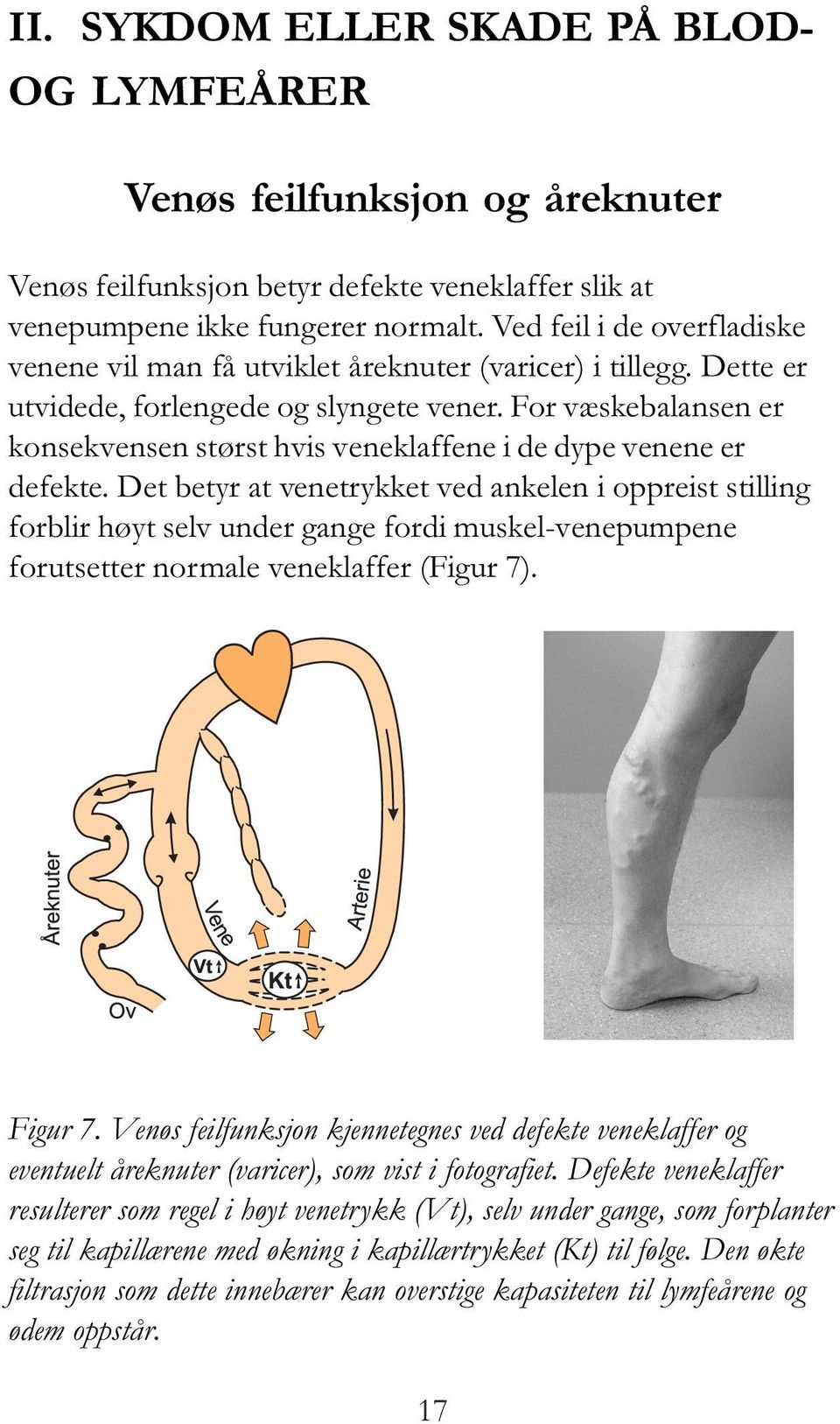 For væskebalansen er konsekvensen størst hvis veneklaffene i de dype venene er defekte.