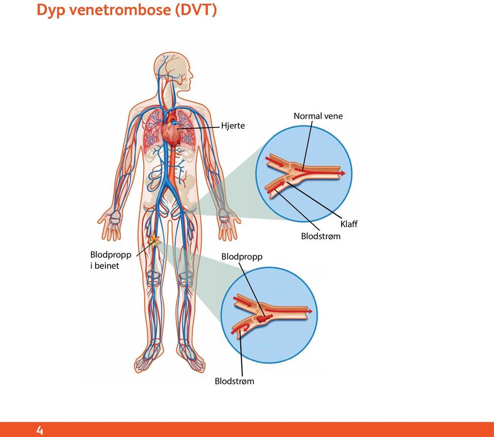 Blodstrøm Blodpropp i