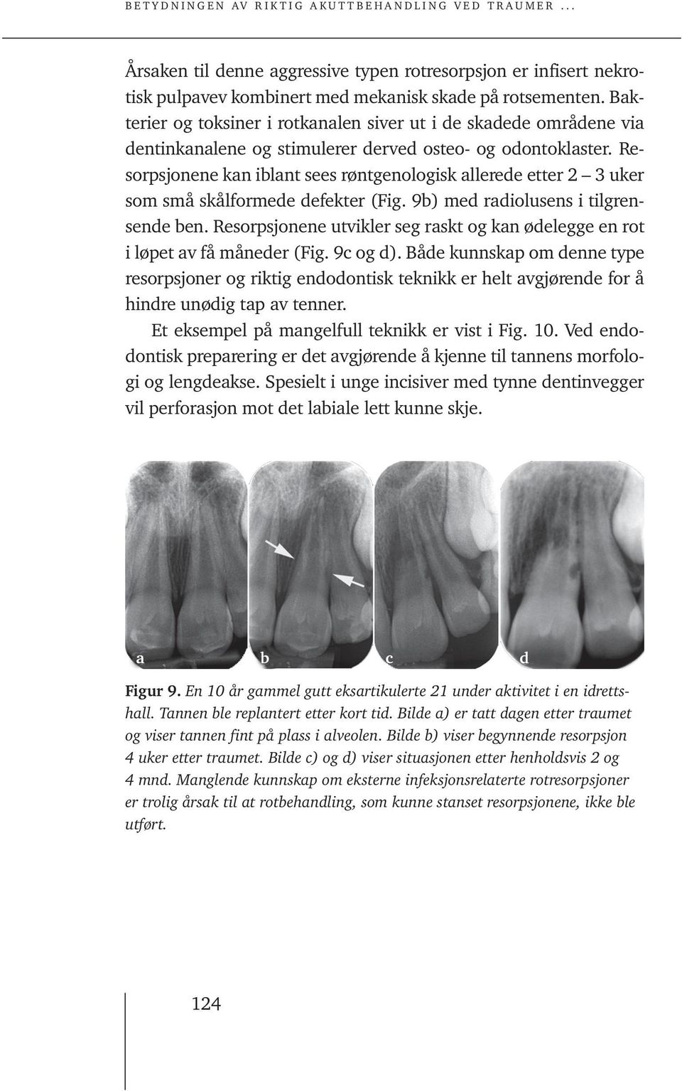 Resorpsjonene kan iblant sees røntgenologisk allerede etter 2 3 uker som små skålformede defekter (Fig. 9b) med radiolusens i tilgrensende ben.