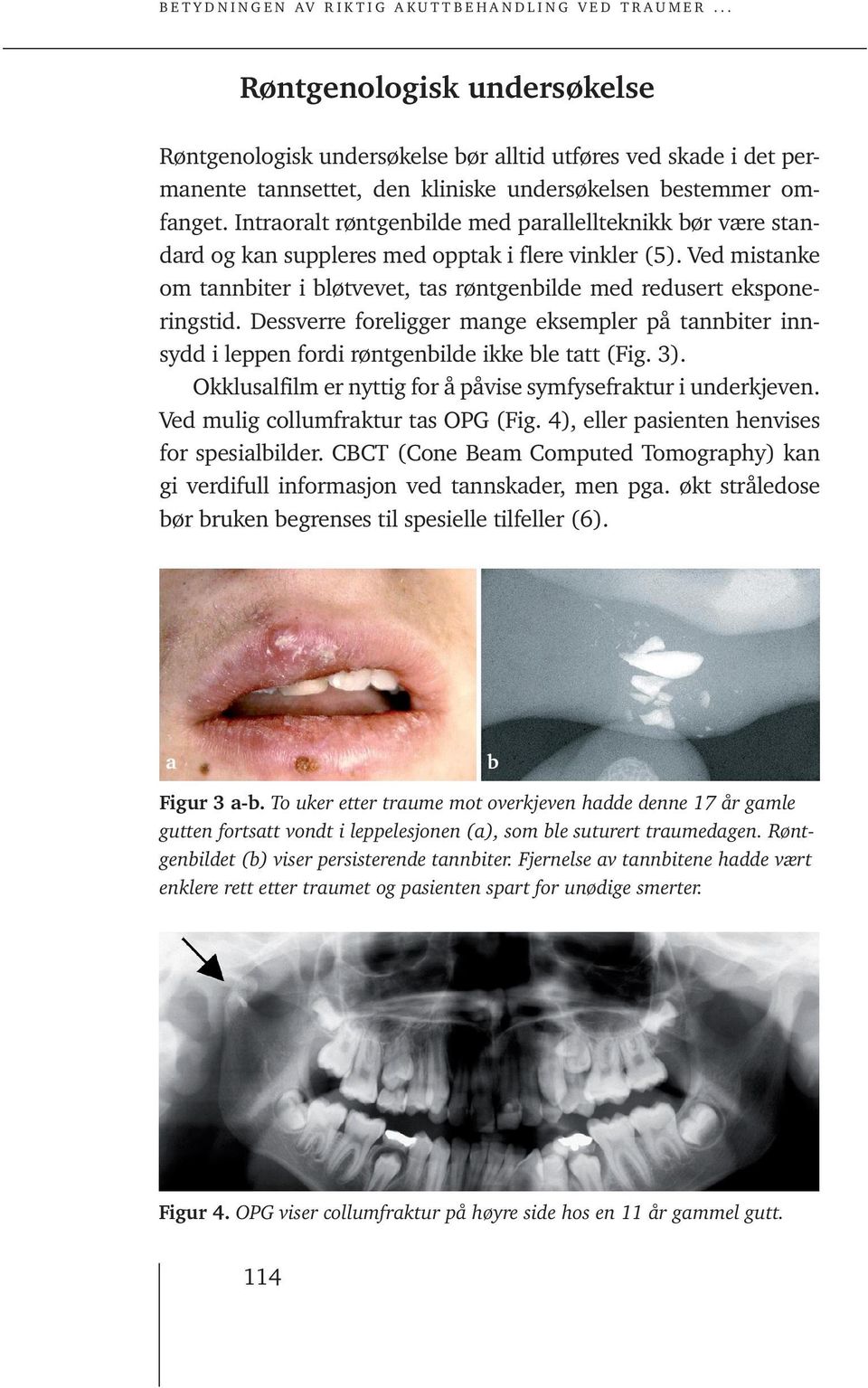 Dessverre foreligger mange eksempler på tannbiter innsydd i leppen fordi røntgenbilde ikke ble tatt (Fig. 3). Okklusalfilm er nyttig for å påvise symfysefraktur i underkjeven.
