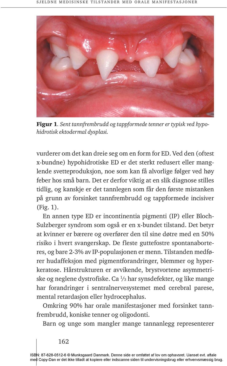 Det er derfor viktig at en slik diagnose stilles tidlig, og kanskje er det tannlegen som får den første mistanken på grunn av forsinket tannfrembrudd og tappformede incisiver (Fig. 1).