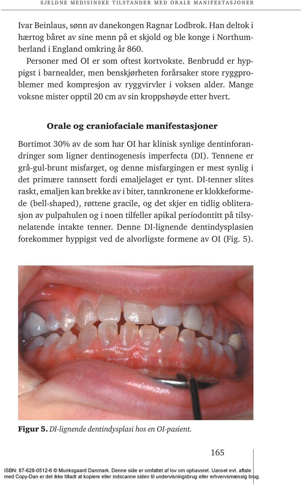 Orale og craniofaciale manifestasjoner Bortimot 30% av de som har OI har klinisk synlige dentinforandringer som ligner dentinogenesis imperfecta (DI).