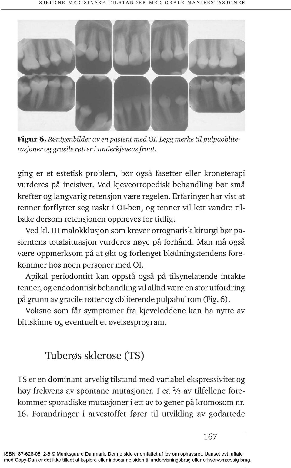 Erfaringer har vist at tenner forflytter seg raskt i OI-ben, og tenner vil lett vandre tilbake dersom retensjonen oppheves for tidlig. Ved kl.