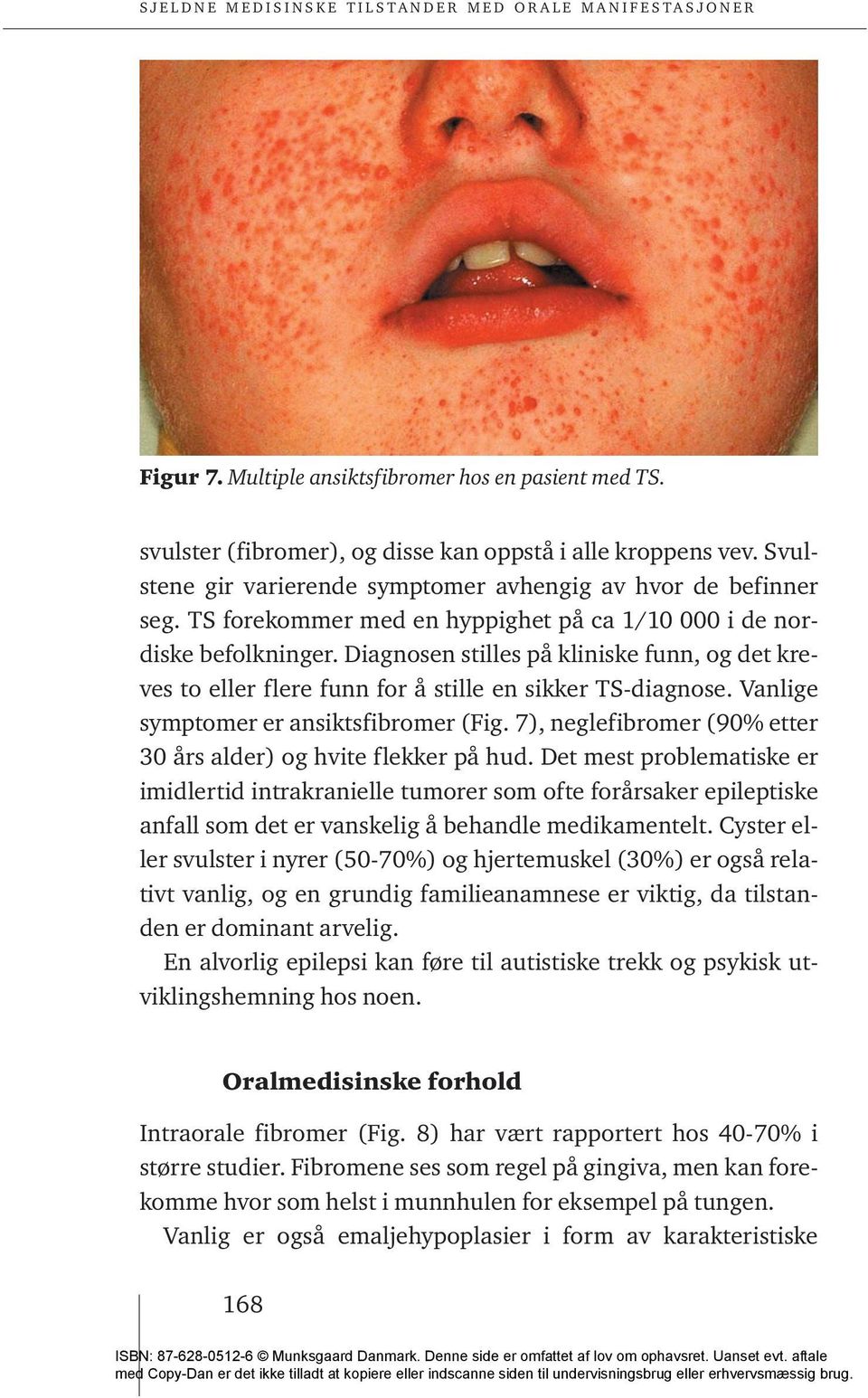 Vanlige symptomer er ansiktsfibromer (Fig. 7), neglefibromer (90% etter 30 års alder) og hvite flekker på hud.