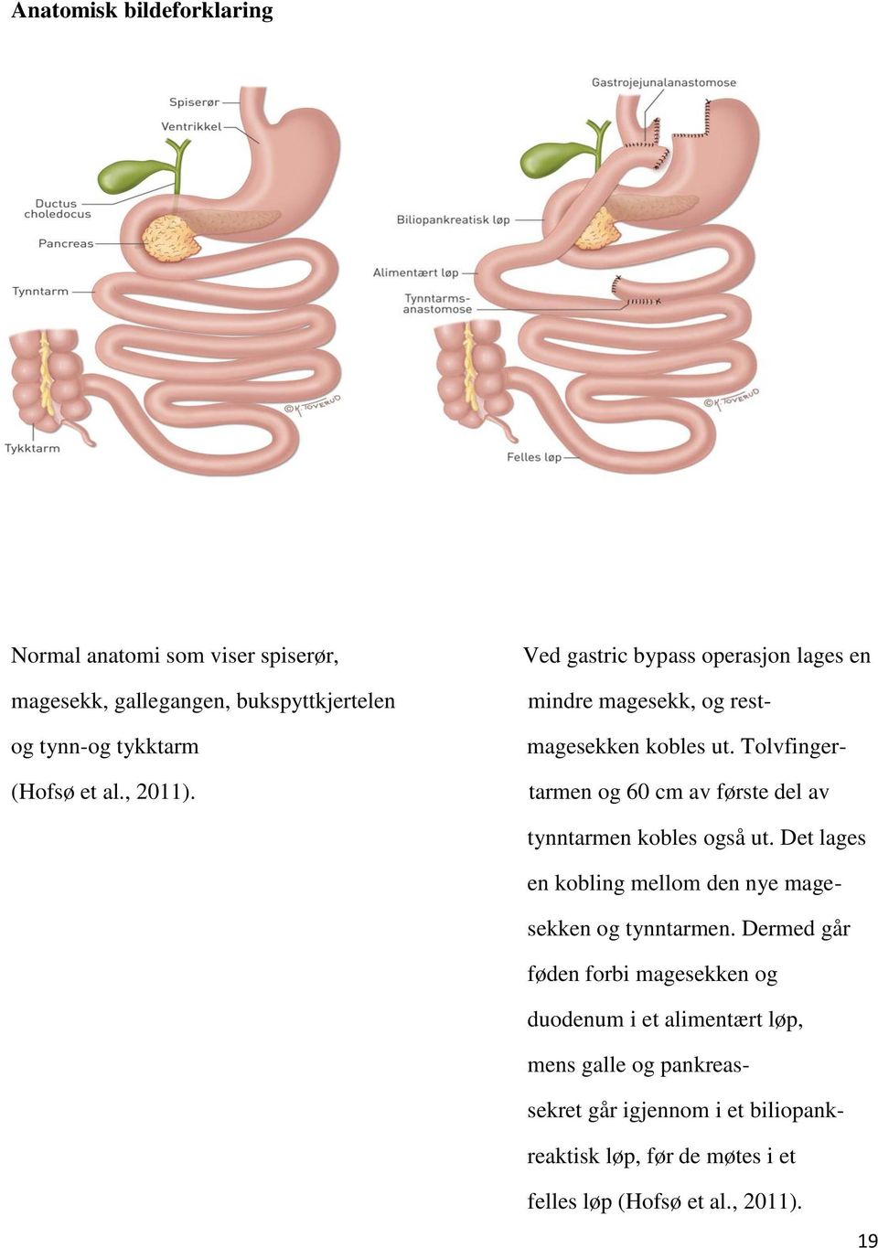 Tolvfingertarmen og 60 cm av første del av tynntarmen kobles også ut. Det lages en kobling mellom den nye magesekken og tynntarmen.