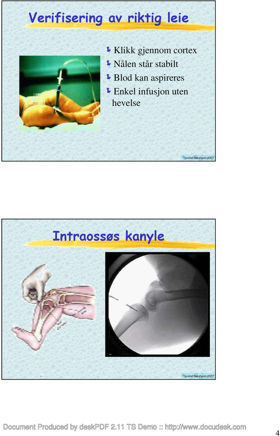 Blod kan aspireres Enkel infusjon