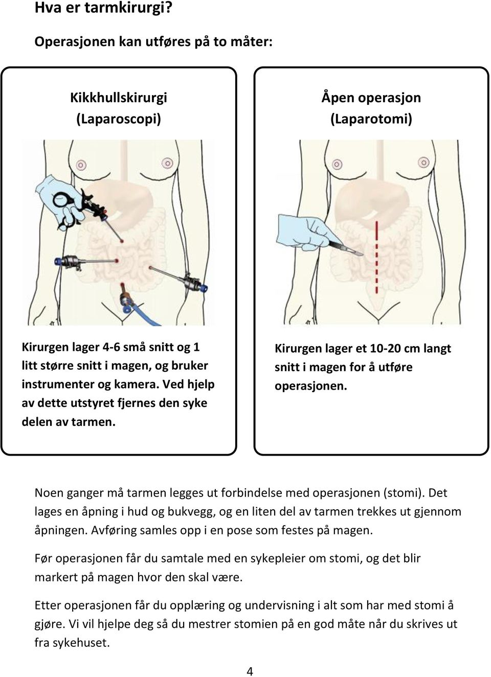 Ved hjelp av dette utstyret fjernes den syke delen av tarmen. Kirurgen lager et 10-20 cm langt snitt i magen for å utføre operasjonen.