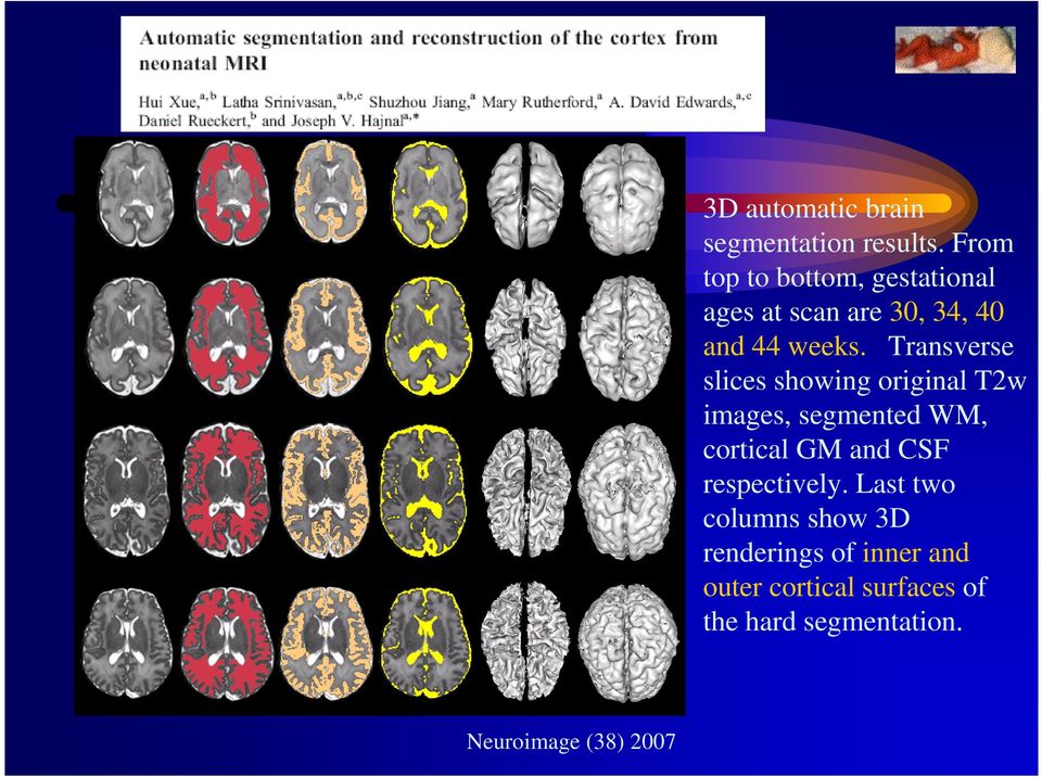Transverse slices showing original T2w images, segmented WM, cortical GM and CSF