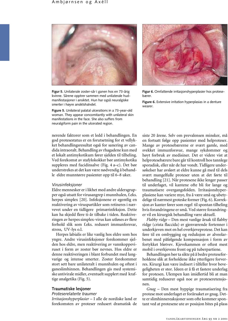 She also suffers from neuralgiform pain in the ulcerated region. Figur 6. Omfattende irritasjonshyperplasier hos protesebærer. Figure 6. Extensive irritation hyperplasias in a denture wearer.