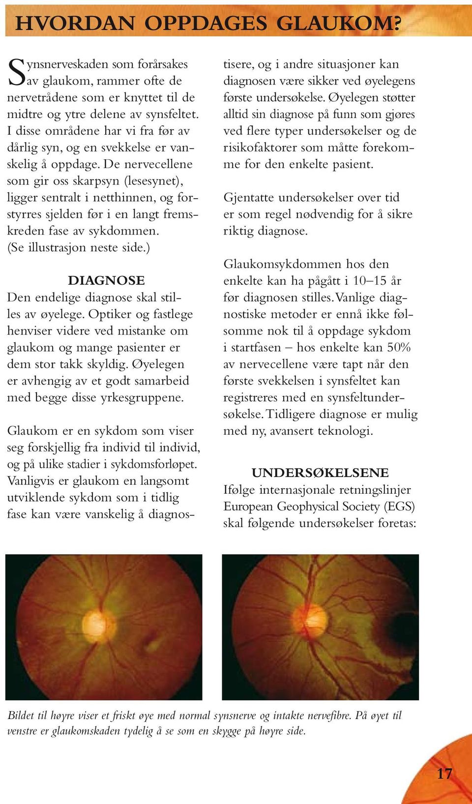 De nervecellene som gir oss skarpsyn (lesesynet), ligger sentralt i netthinnen, og forstyrres sjelden før i en langt fremskreden fase av sykdommen. (Se illustrasjon neste side.