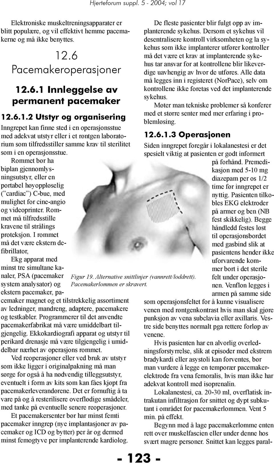 .6.1 Innleggelse av permanent pacemaker 12.6.1.2 Utstyr og organisering Inngrepet kan finne sted i en operasjonsstue med adekvat utstyr eller i et røntgen laboratorium som tilfredsstiller samme krav til sterilitet som i en operasjonsstue.