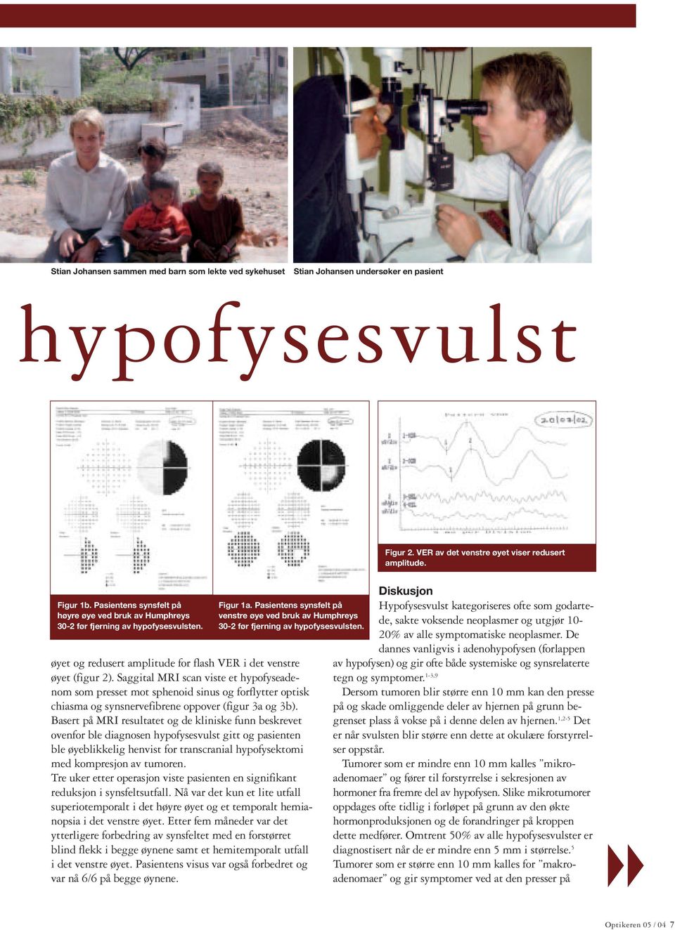 øyet og redusert amplitude for flash VER i det venstre øyet (figur 2).