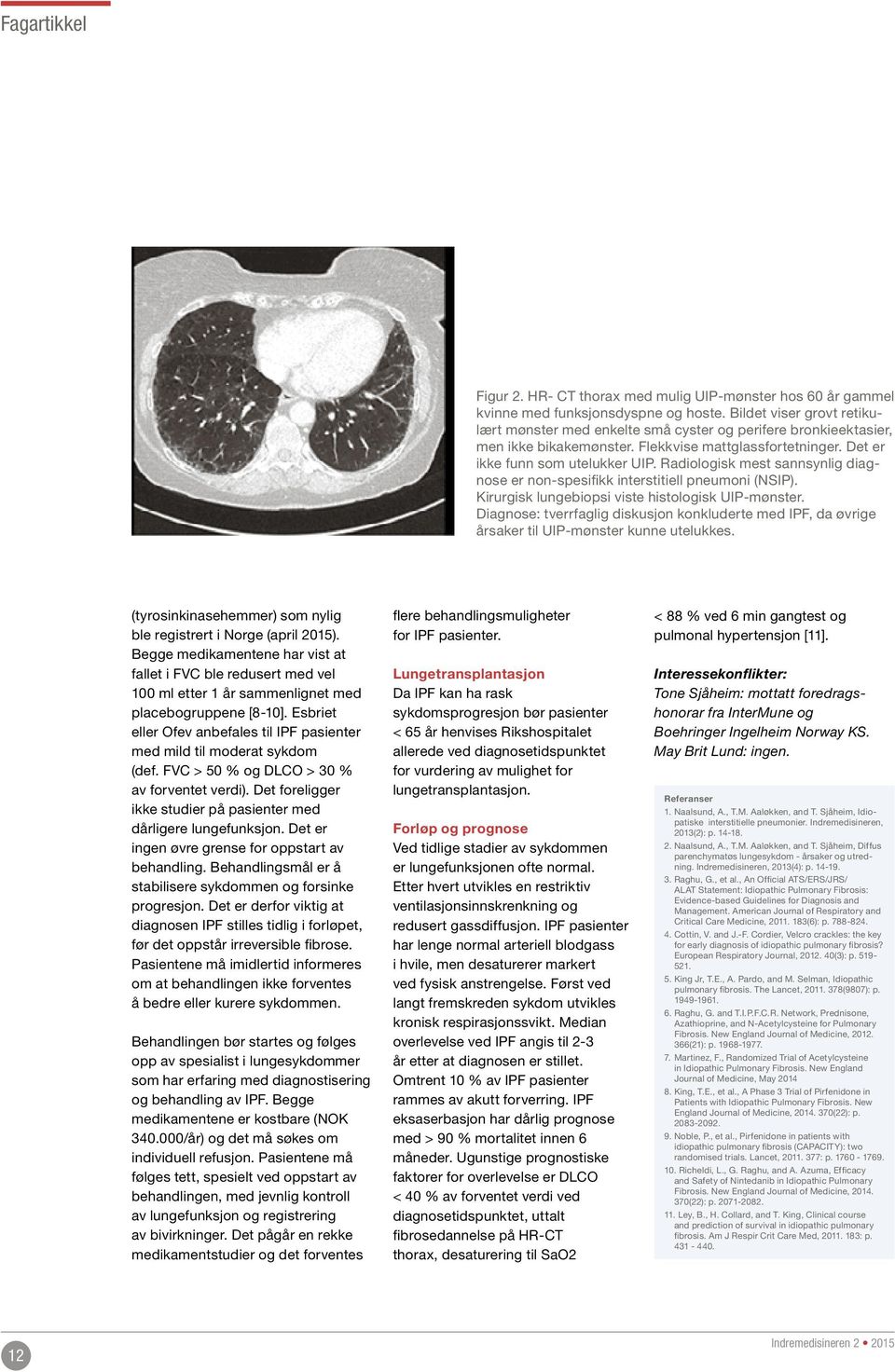 Radiologisk mest sannsynlig diagnose er non-spesifikk interstitiell pneumoni (NSIP). Kirurgisk lungebiopsi viste histologisk UIP-mønster.