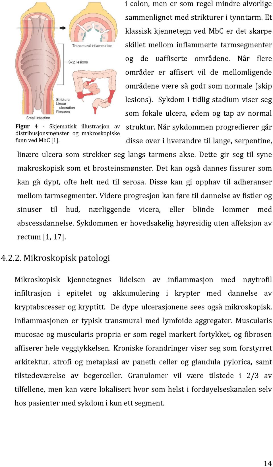 Når flere områder er affisert vil de mellomligende områdene være så godt som normale (skip lesions). Sykdom i tidlig stadium viser seg som fokale ulcera, ødem og tap av normal struktur.