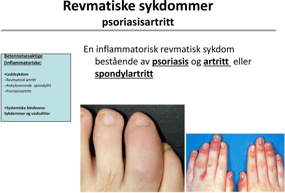 spondylitt Psoriasisartritt En inflammatorisk revmatisk sykdom