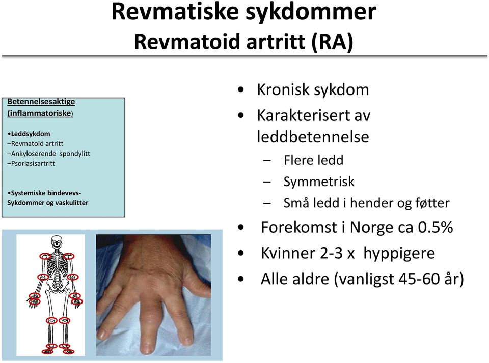 og vaskulitter Kronisk sykdom Karakterisert av leddbetennelse Flere ledd Symmetrisk Små ledd