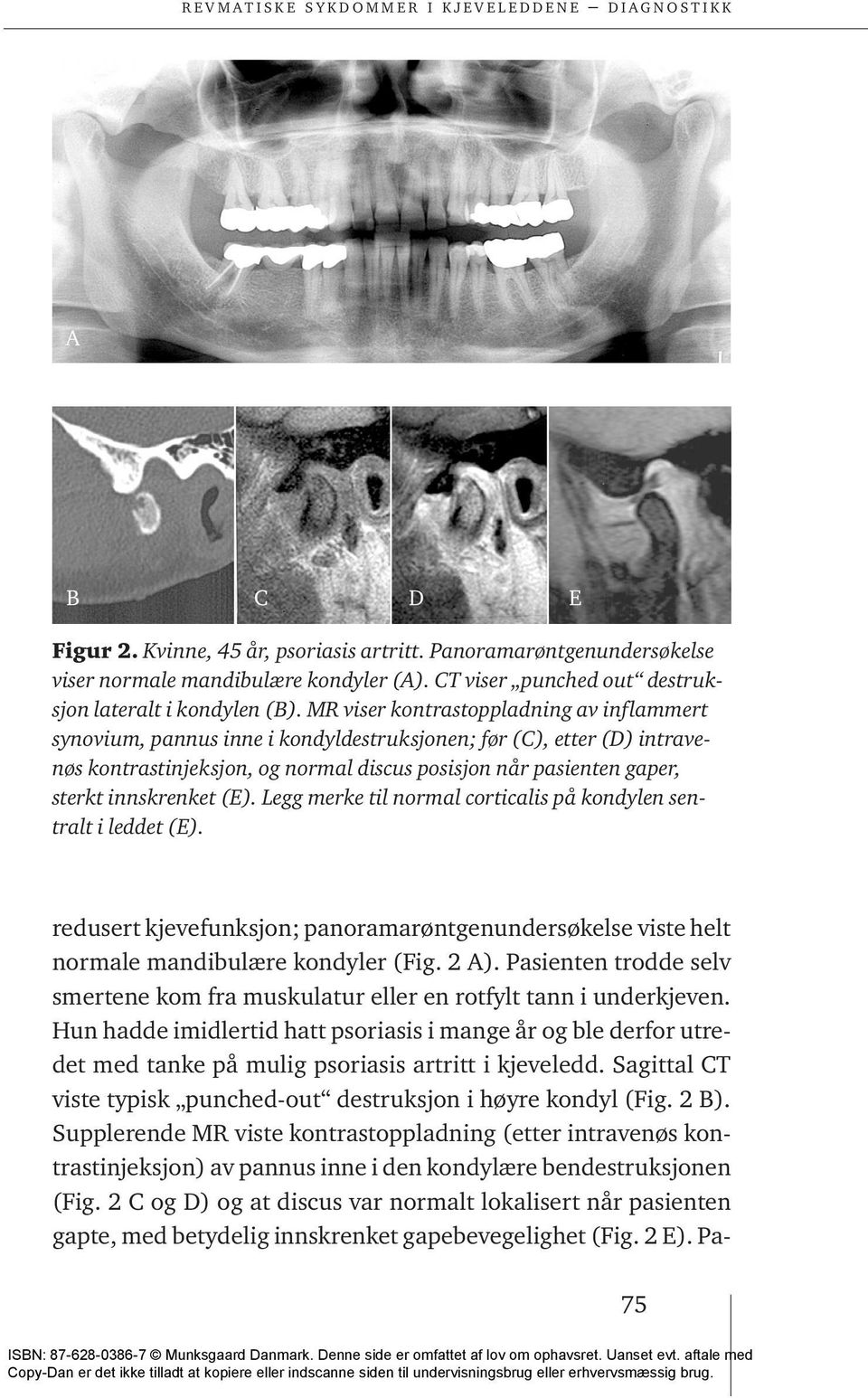 innskrenket (E). Legg merke til normal corticalis på kondylen sentralt i leddet (E). redusert kjevefunksjon; panoramarøntgenundersøkelse viste helt normale mandibulære kondyler (Fig. 2 A).