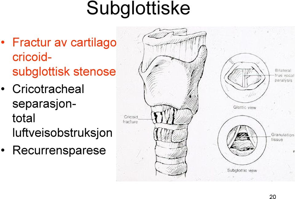 stenose Cricotracheal