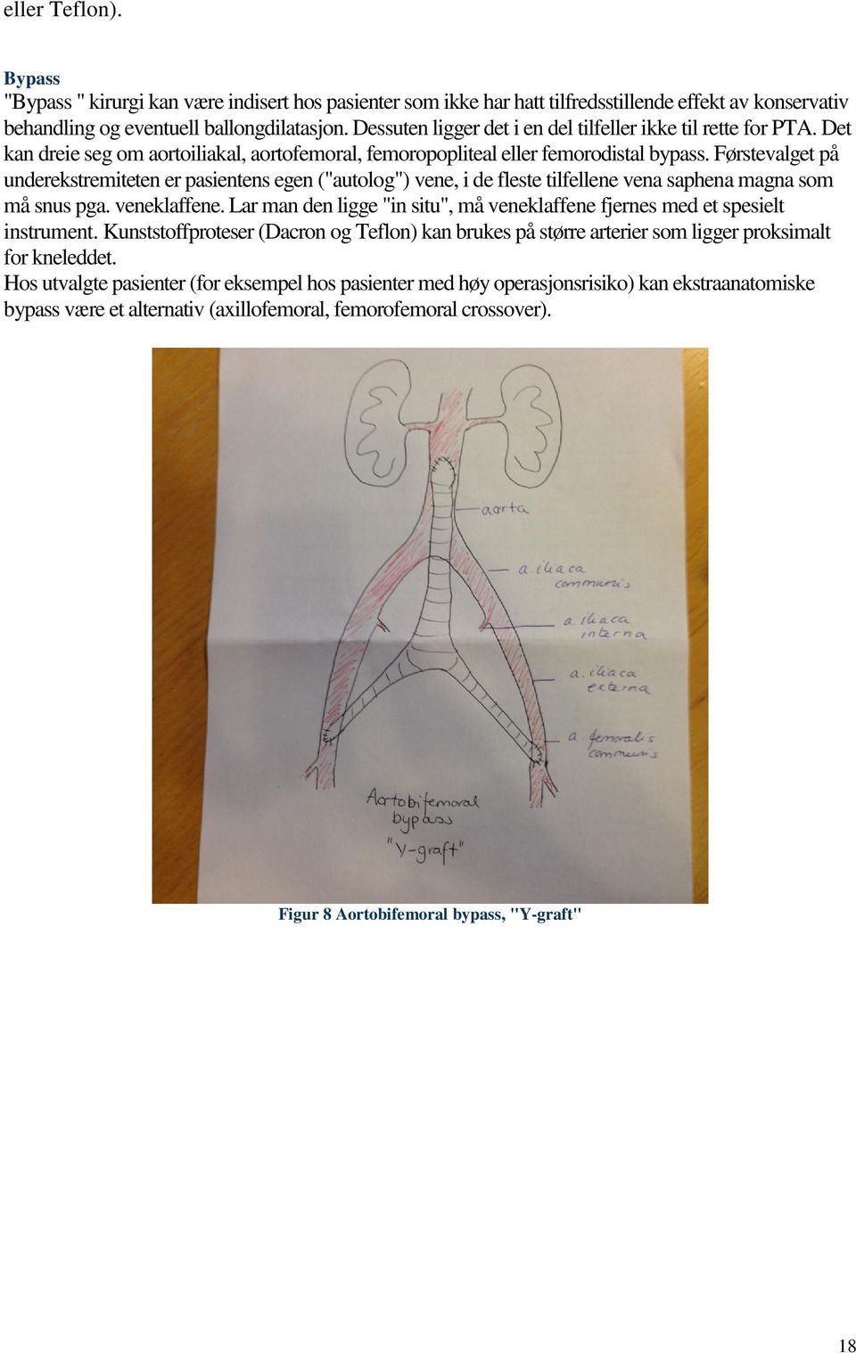 Førstevalget på underekstremiteten er pasientens egen ("autolog") vene, i de fleste tilfellene vena saphena magna som må snus pga. veneklaffene.