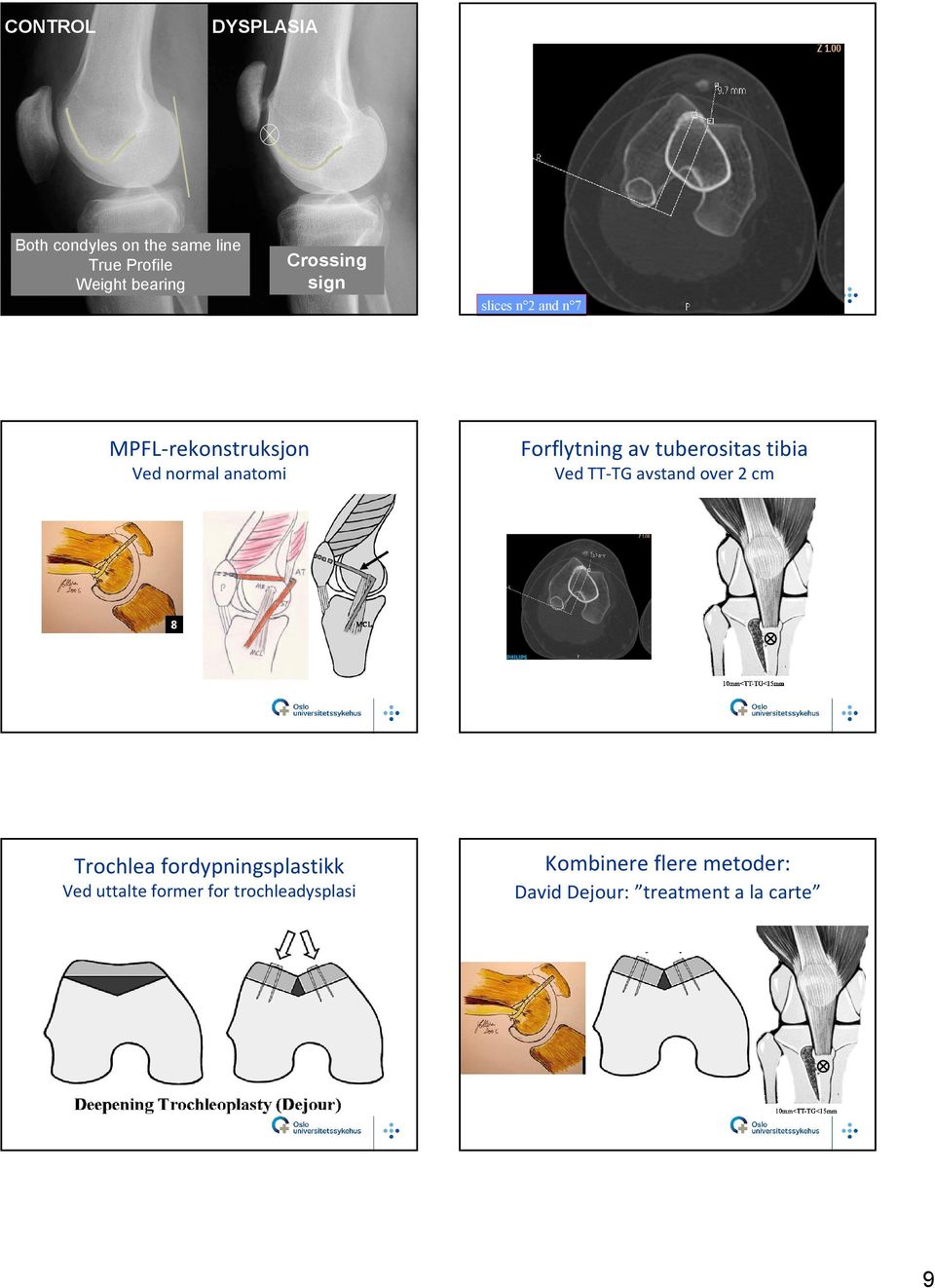 tibia Ved normal anatomi Ved TT-TG avstand over 2 cm Trochlea fordypningsplastikk