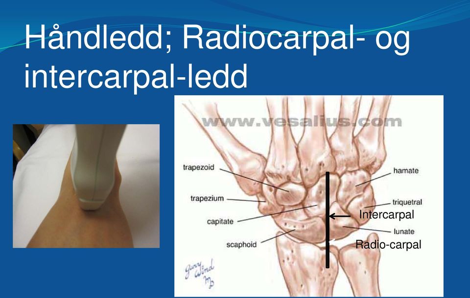 intercarpal-ledd